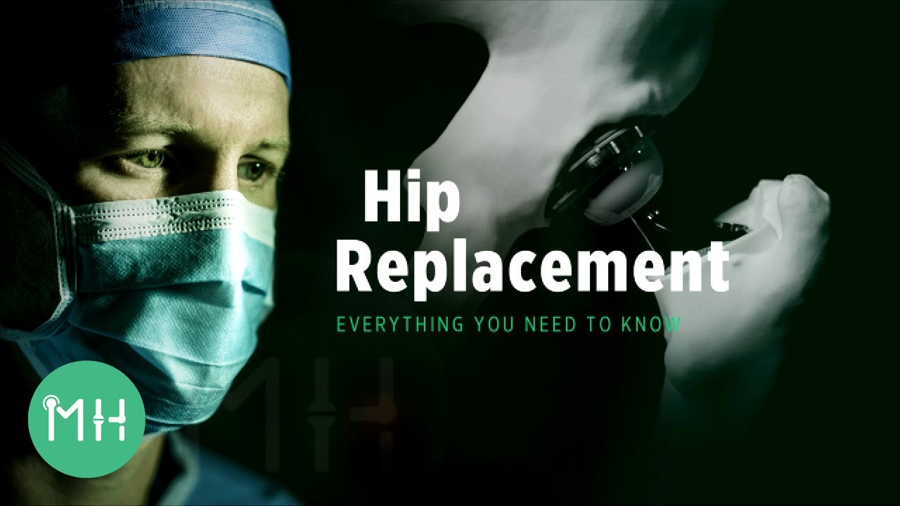 Hip Replacement – Everything you need to know